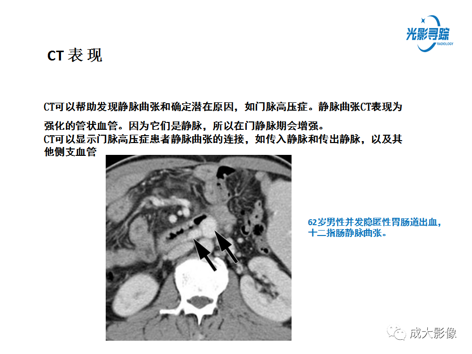 影像PPT - 【PPT】胃肠道上皮下富血供肿瘤及肿瘤样病变的CT表现-43