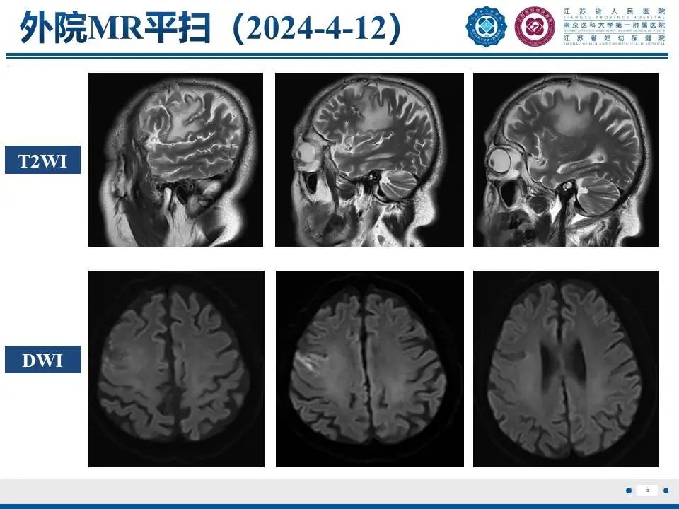 影像PPT - 【PPT】亚急性期脑梗死-4