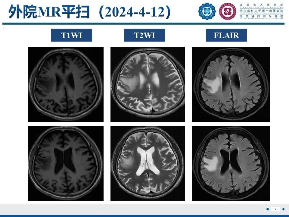 影像PPT - 【PPT】亚急性期脑梗死-3