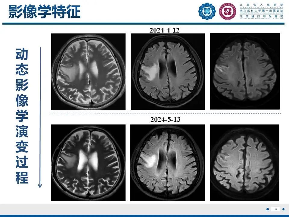 影像PPT - 【PPT】亚急性期脑梗死-11