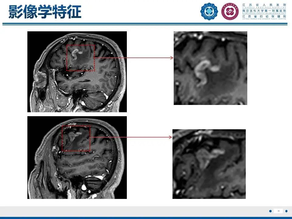 影像PPT - 【PPT】亚急性期脑梗死-12