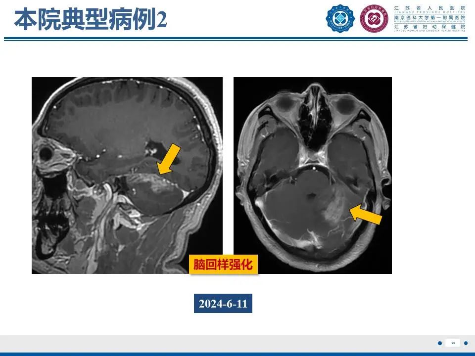 影像PPT - 【PPT】亚急性期脑梗死-25