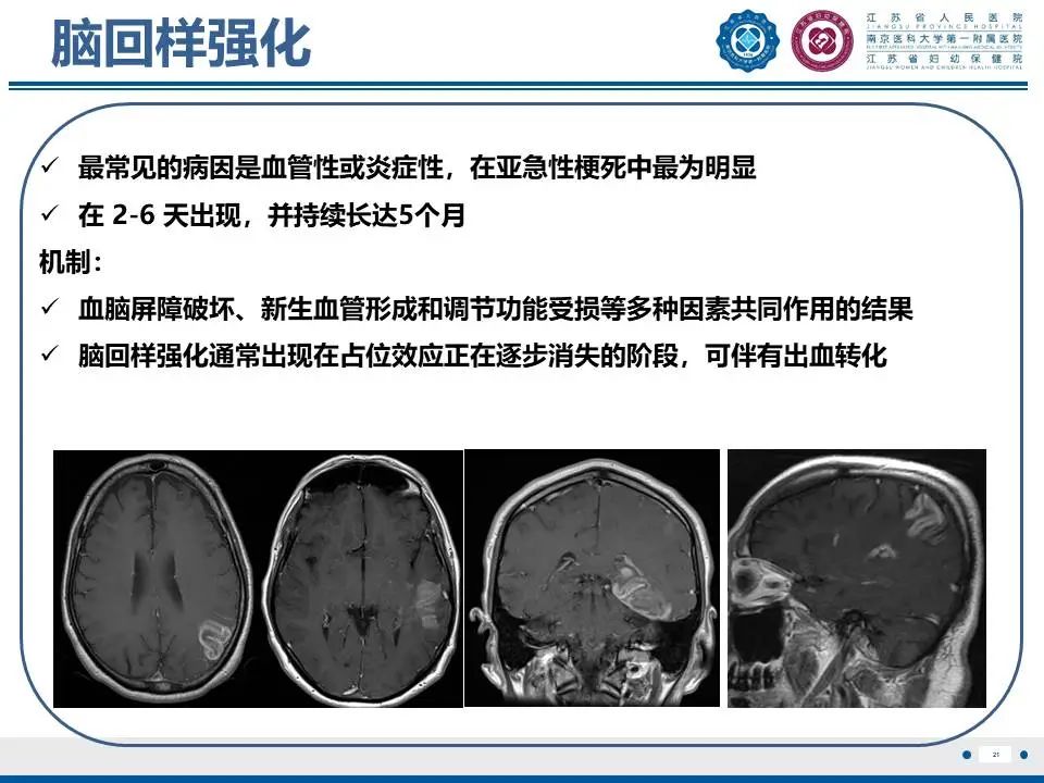 影像PPT - 【PPT】亚急性期脑梗死-21