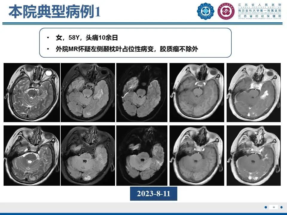 影像PPT - 【PPT】亚急性期脑梗死-22