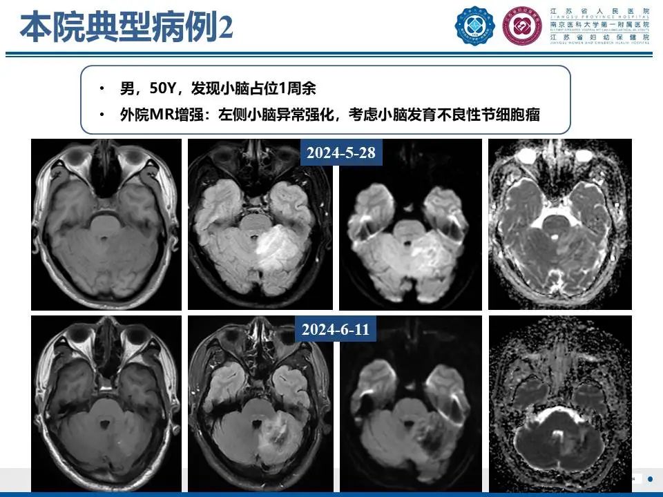 影像PPT - 【PPT】亚急性期脑梗死-24