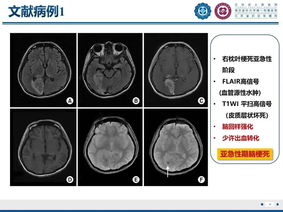 影像PPT - 【PPT】亚急性期脑梗死-26