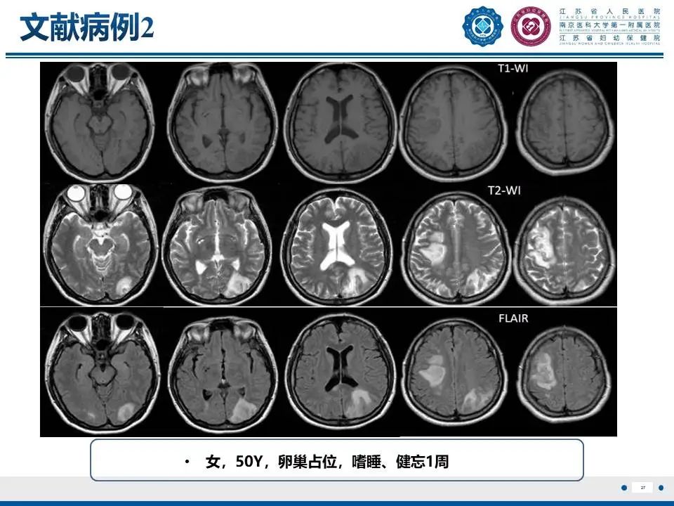 影像PPT - 【PPT】亚急性期脑梗死-27