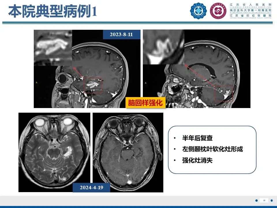 影像PPT - 【PPT】亚急性期脑梗死-23