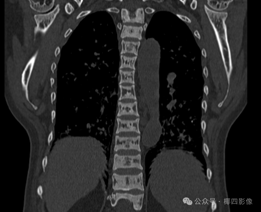 影像PPT - 肾性骨病之橄榄球衣征 (rugger-jersey spine),至今无人完美解释的骨质硬化之谜-3 影像PPT - 肾性骨病之橄榄球衣征 (rugger-jersey spine),至今无人完美解释的骨质硬化之谜-3