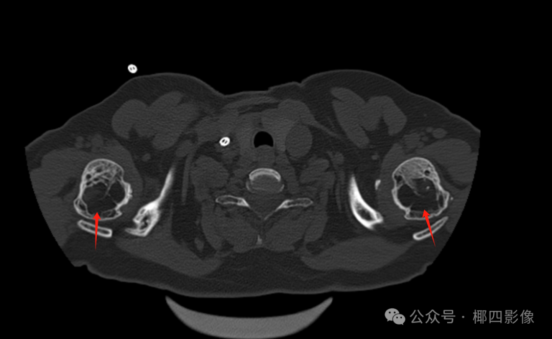 影像PPT - 肾性骨病之橄榄球衣征 (rugger-jersey spine),至今无人完美解释的骨质硬化之谜-5 影像PPT - 肾性骨病之橄榄球衣征 (rugger-jersey spine),至今无人完美解释的骨质硬化之谜-5