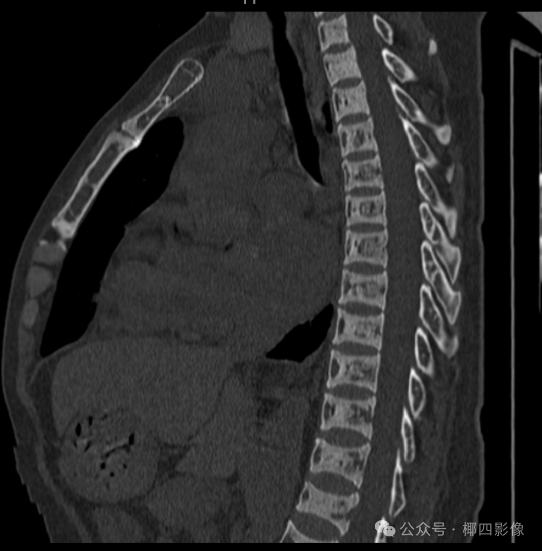 影像PPT - 肾性骨病之橄榄球衣征 (rugger-jersey spine),至今无人完美解释的骨质硬化之谜-2 影像PPT - 肾性骨病之橄榄球衣征 (rugger-jersey spine),至今无人完美解释的骨质硬化之谜-2