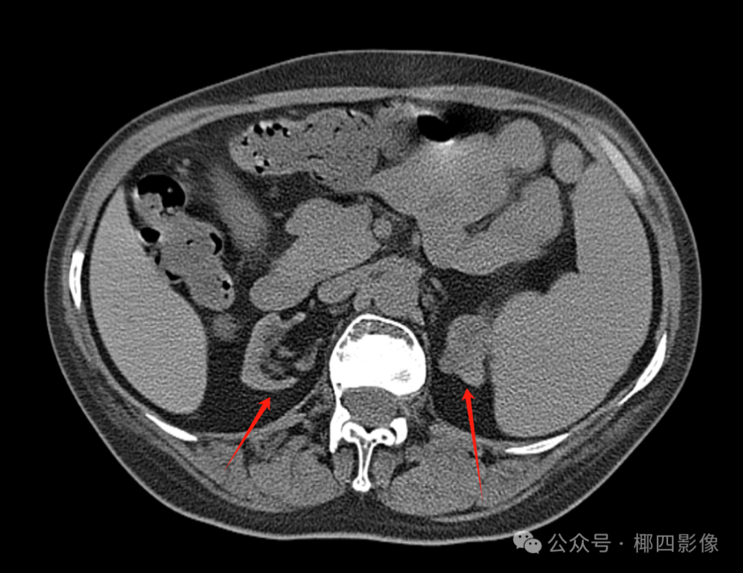 影像PPT - 肾性骨病之橄榄球衣征 (rugger-jersey spine),至今无人完美解释的骨质硬化之谜-4 影像PPT - 肾性骨病之橄榄球衣征 (rugger-jersey spine),至今无人完美解释的骨质硬化之谜-4