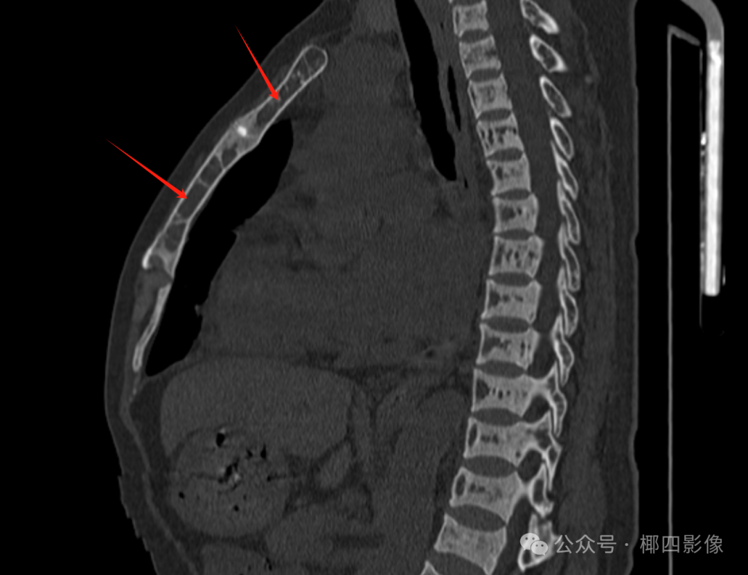 影像PPT - 肾性骨病之橄榄球衣征 (rugger-jersey spine),至今无人完美解释的骨质硬化之谜-6 影像PPT - 肾性骨病之橄榄球衣征 (rugger-jersey spine),至今无人完美解释的骨质硬化之谜-6