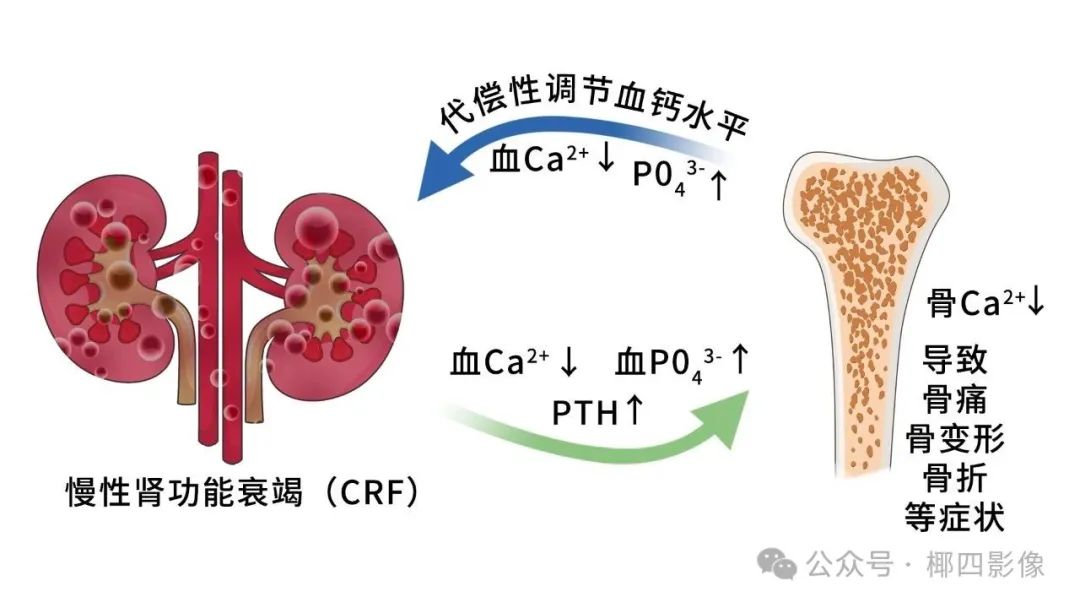 影像PPT - 肾性骨病之橄榄球衣征 (rugger-jersey spine),至今无人完美解释的骨质硬化之谜-7 影像PPT - 肾性骨病之橄榄球衣征 (rugger-jersey spine),至今无人完美解释的骨质硬化之谜-7