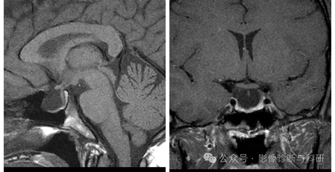 影像PPT - 完全/部分空泡蝶鞍的诊断及分级标准-4 影像PPT - 完全/部分空泡蝶鞍的诊断及分级标准-4
