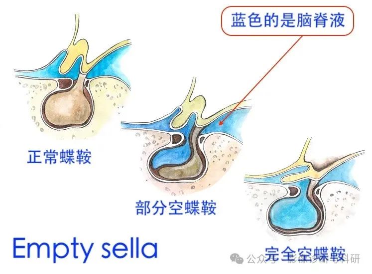 影像PPT - 完全/部分空泡蝶鞍的诊断及分级标准-1 影像PPT - 完全/部分空泡蝶鞍的诊断及分级标准-1