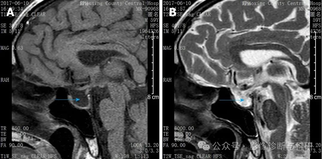 影像PPT - 完全/部分空泡蝶鞍的诊断及分级标准-5