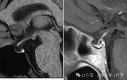 影像PPT - 完全/部分空泡蝶鞍的诊断及分级标准-7 影像PPT - 完全/部分空泡蝶鞍的诊断及分级标准-7