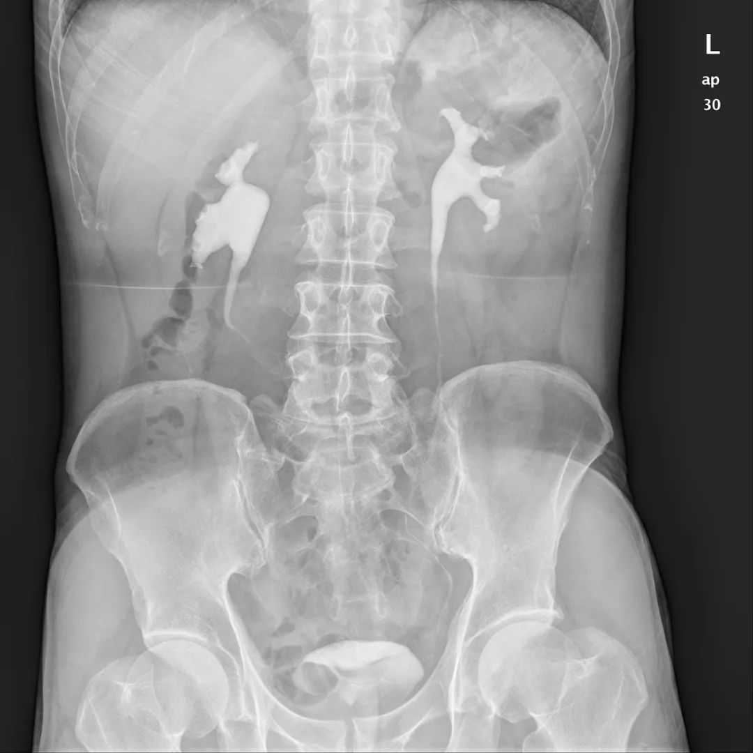 影像PPT - 【病例】壶腹型肾盂4例X线影像-1 影像PPT - 【病例】壶腹型肾盂4例X线影像-1