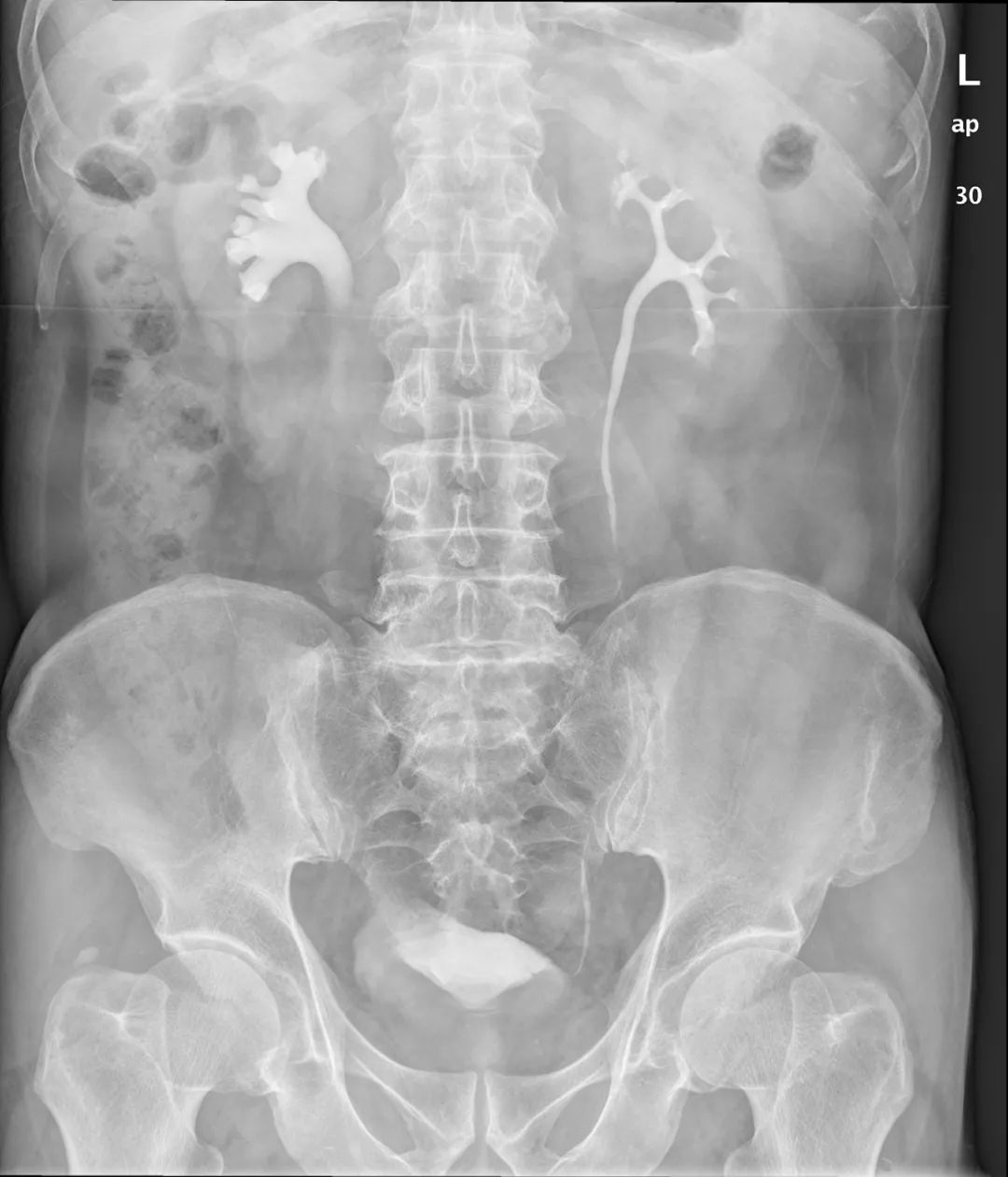 影像PPT - 【病例】壶腹型肾盂4例X线影像-3 影像PPT - 【病例】壶腹型肾盂4例X线影像-3