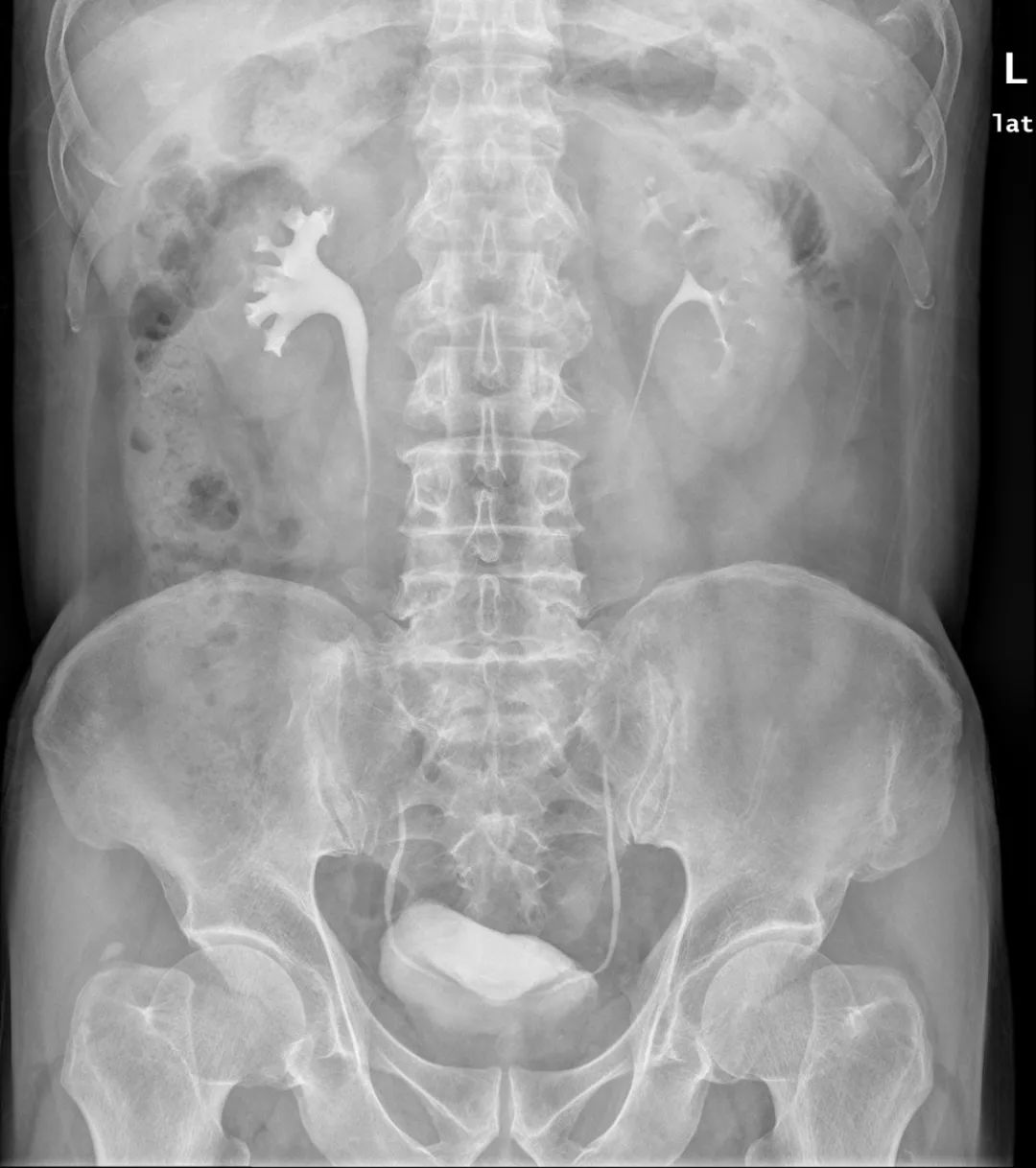 影像PPT - 【病例】壶腹型肾盂4例X线影像-2 影像PPT - 【病例】壶腹型肾盂4例X线影像-2