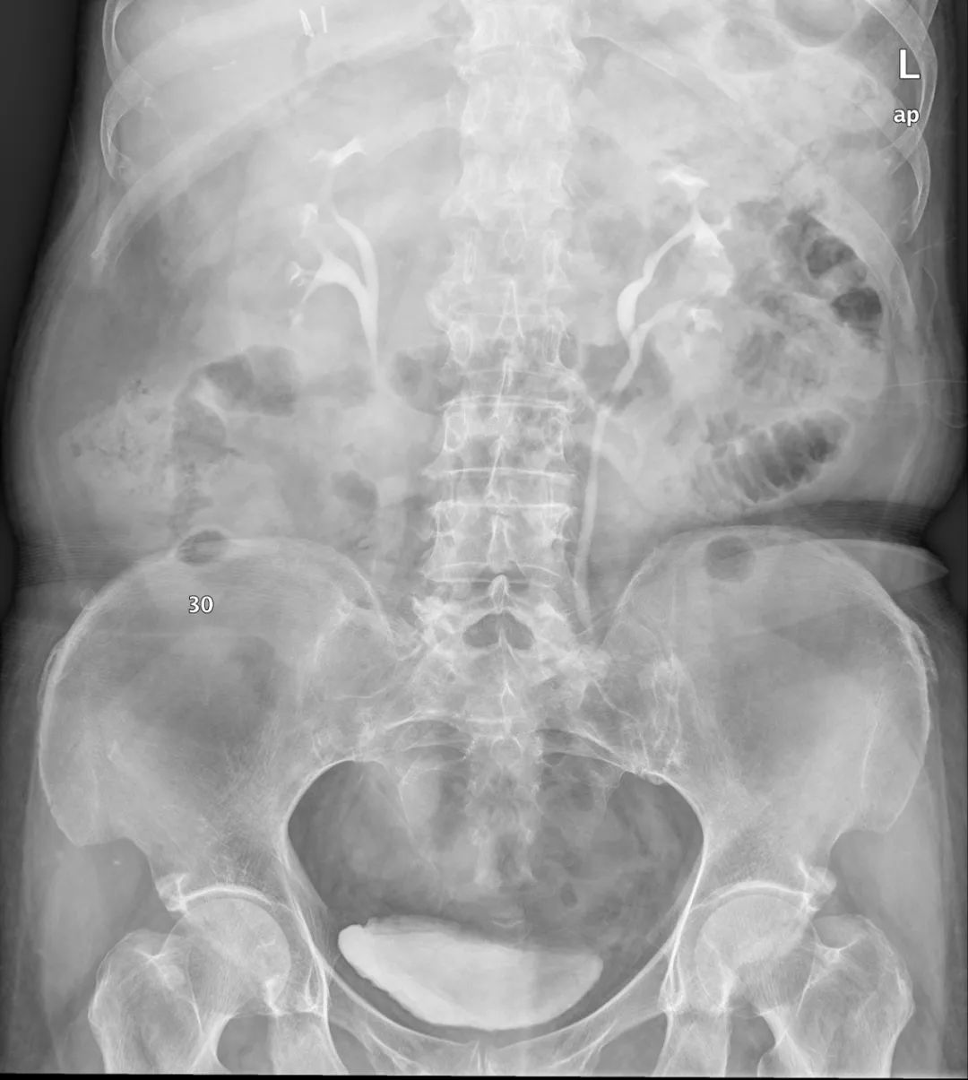 影像PPT - 【病例】壶腹型肾盂4例X线影像-5 影像PPT - 【病例】壶腹型肾盂4例X线影像-5