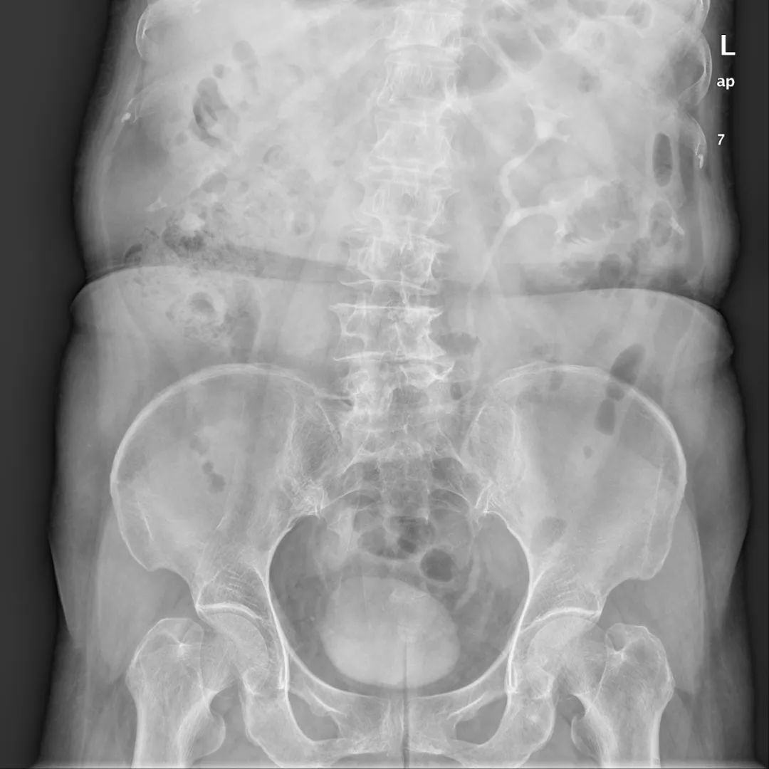 影像PPT - 【病例】壶腹型肾盂4例X线影像-6 影像PPT - 【病例】壶腹型肾盂4例X线影像-6