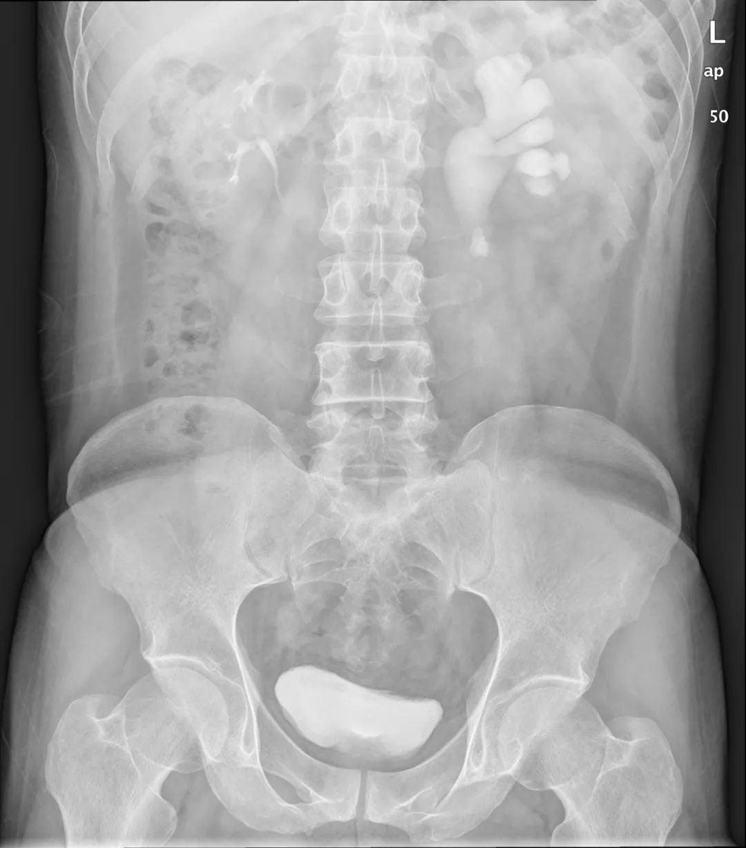 影像PPT - 【病例】壶腹型肾盂4例X线影像-7 影像PPT - 【病例】壶腹型肾盂4例X线影像-7