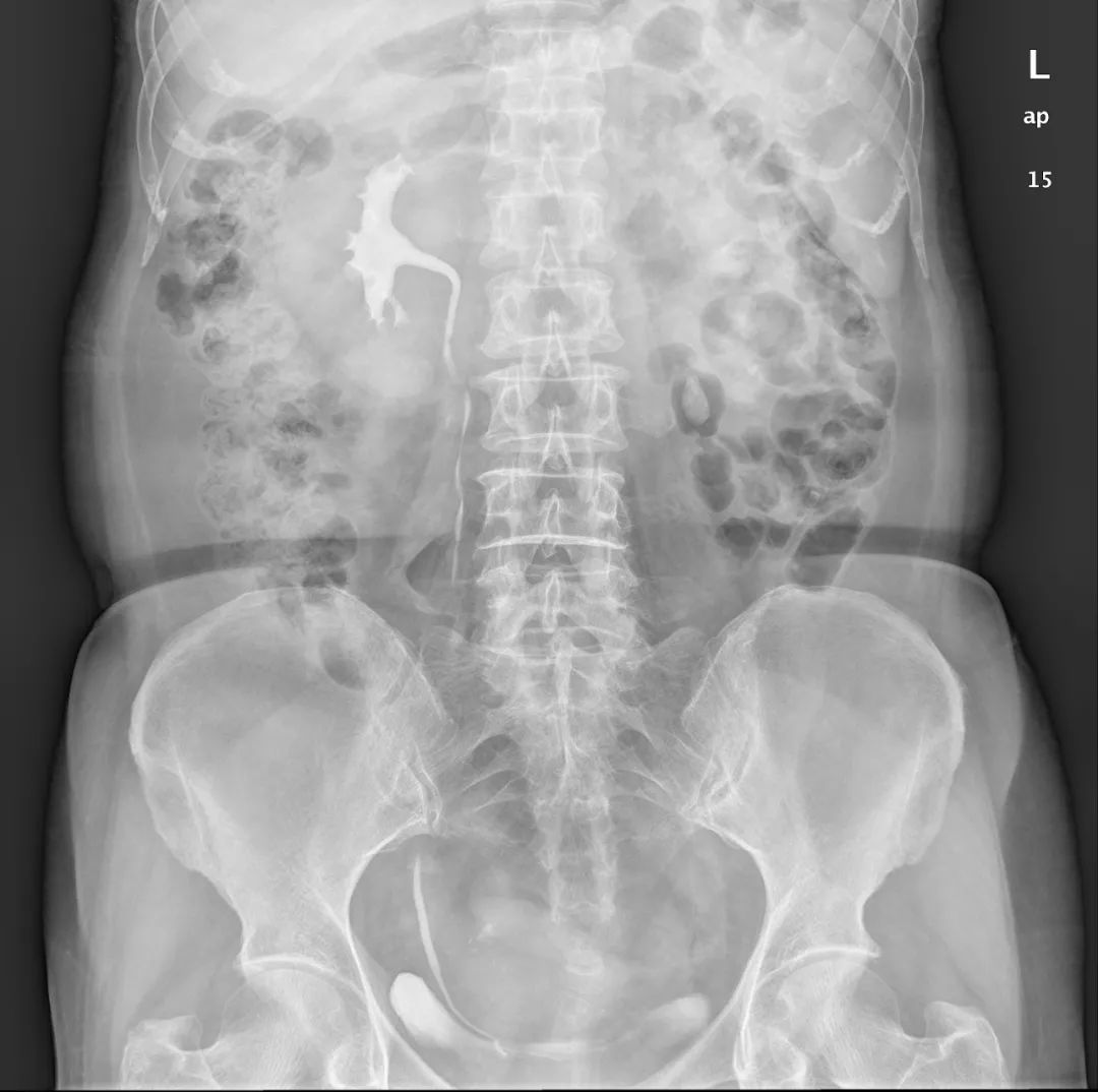 影像PPT - 【病例】壶腹型肾盂4例X线影像-1 影像PPT - 【病例】壶腹型肾盂4例X线影像-1