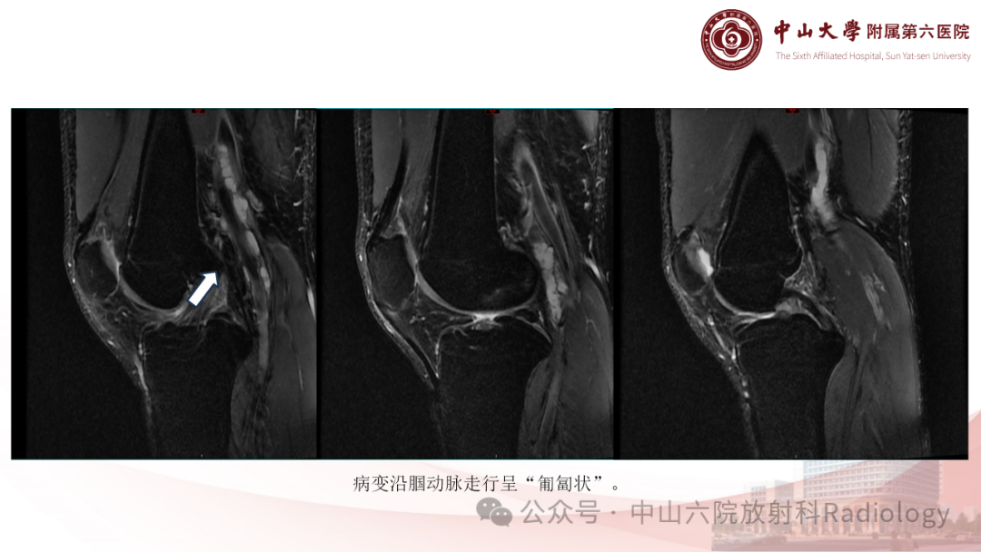 影像PPT - 【PPT】囊性动脉外膜病-13