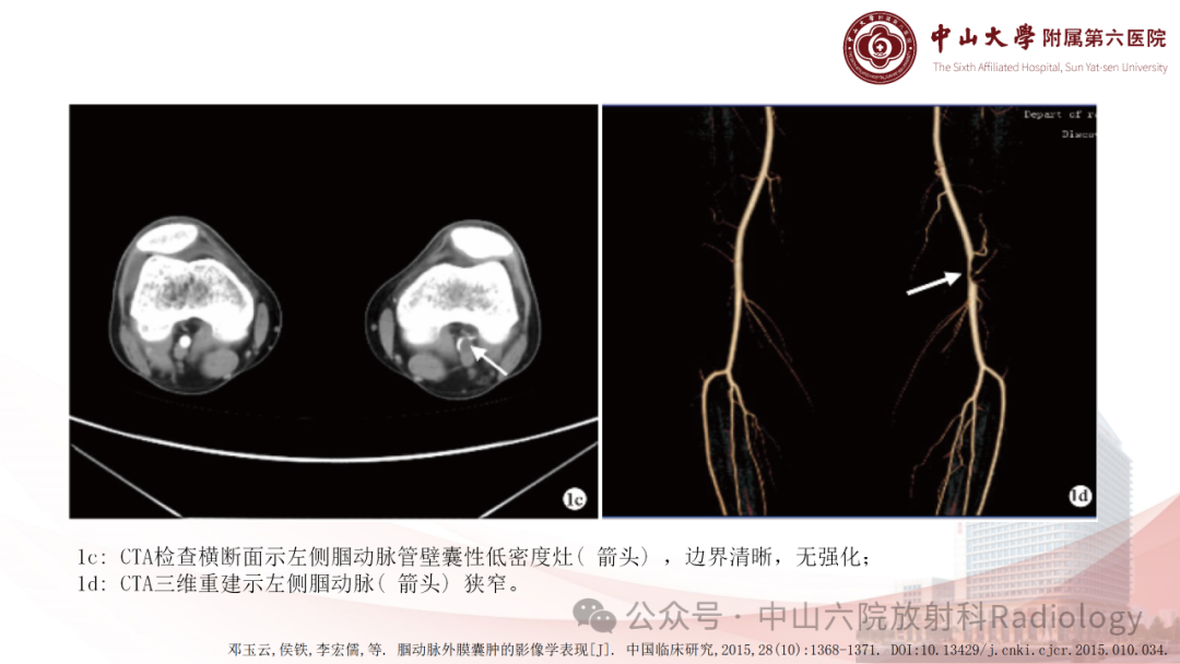影像PPT - 【PPT】囊性动脉外膜病-12