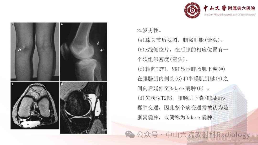 影像PPT - 【PPT】囊性动脉外膜病-17