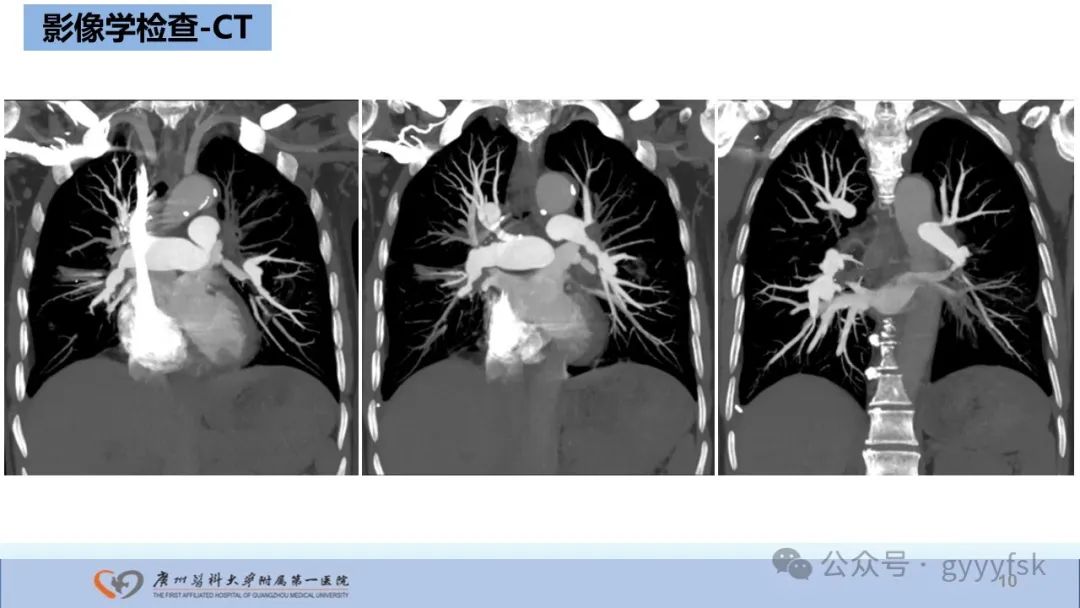 影像PPT - 【PPT】纤维素性纵隔炎-10