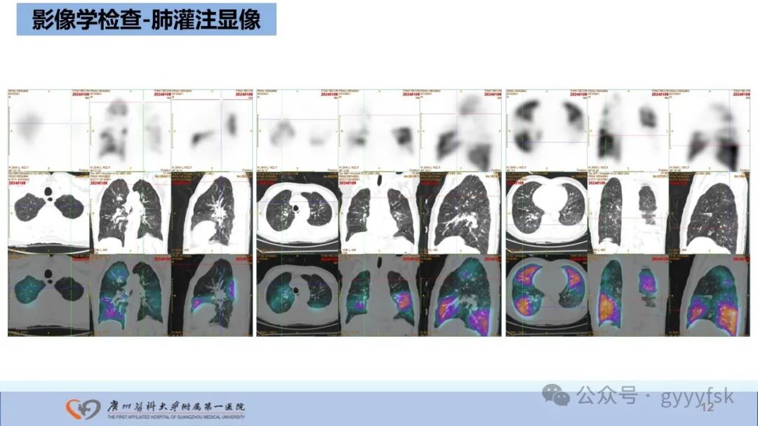 影像PPT - 【PPT】纤维素性纵隔炎-12