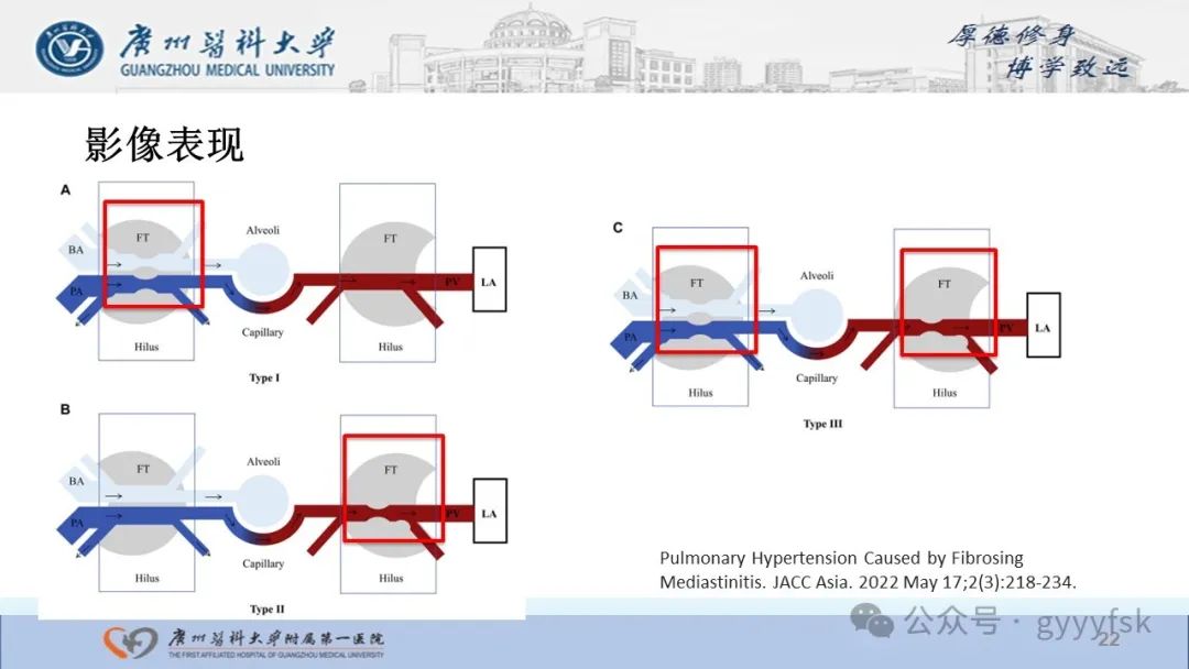 影像PPT - 【PPT】纤维素性纵隔炎-22