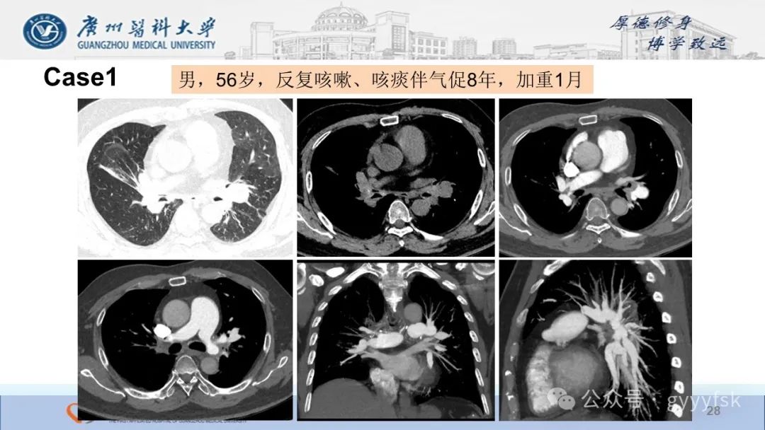 影像PPT - 【PPT】纤维素性纵隔炎-28