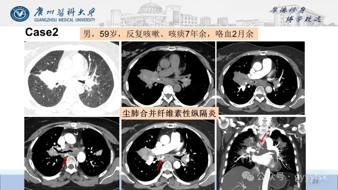 影像PPT - 【PPT】纤维素性纵隔炎-29
