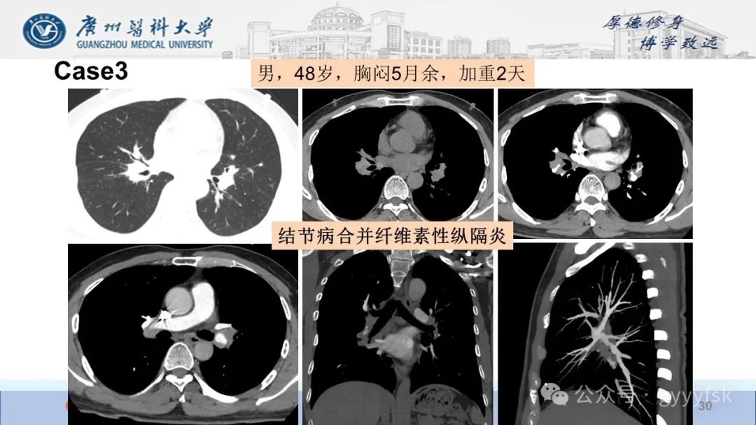 影像PPT - 【PPT】纤维素性纵隔炎-30