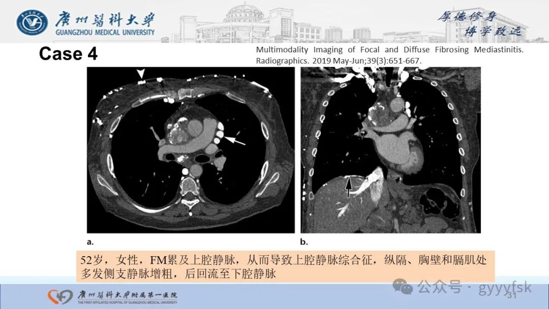影像PPT - 【PPT】纤维素性纵隔炎-31