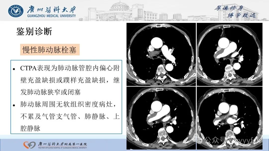 影像PPT - 【PPT】纤维素性纵隔炎-33