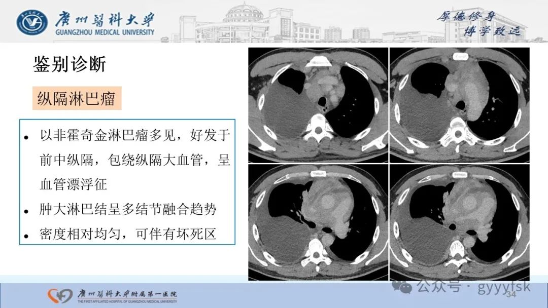 影像PPT - 【PPT】纤维素性纵隔炎-34