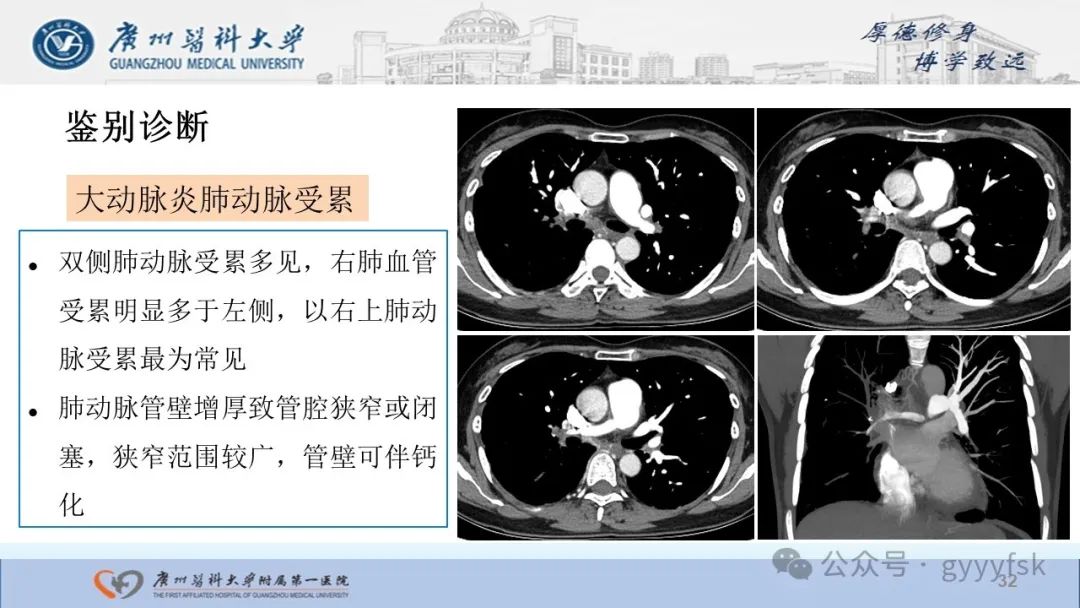 影像PPT - 【PPT】纤维素性纵隔炎-32