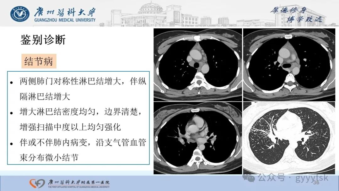 影像PPT - 【PPT】纤维素性纵隔炎-36