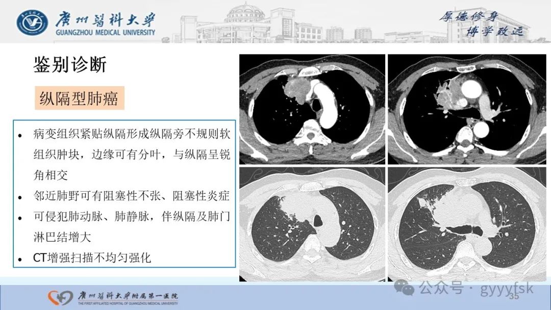 影像PPT - 【PPT】纤维素性纵隔炎-35