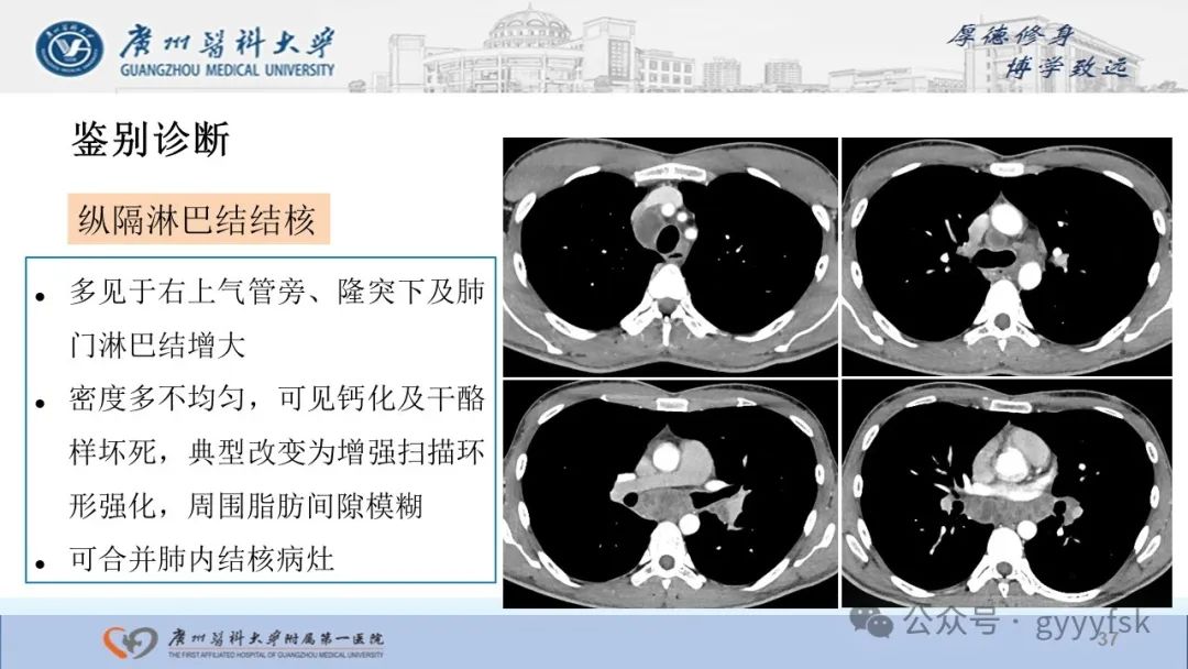 影像PPT - 【PPT】纤维素性纵隔炎-37