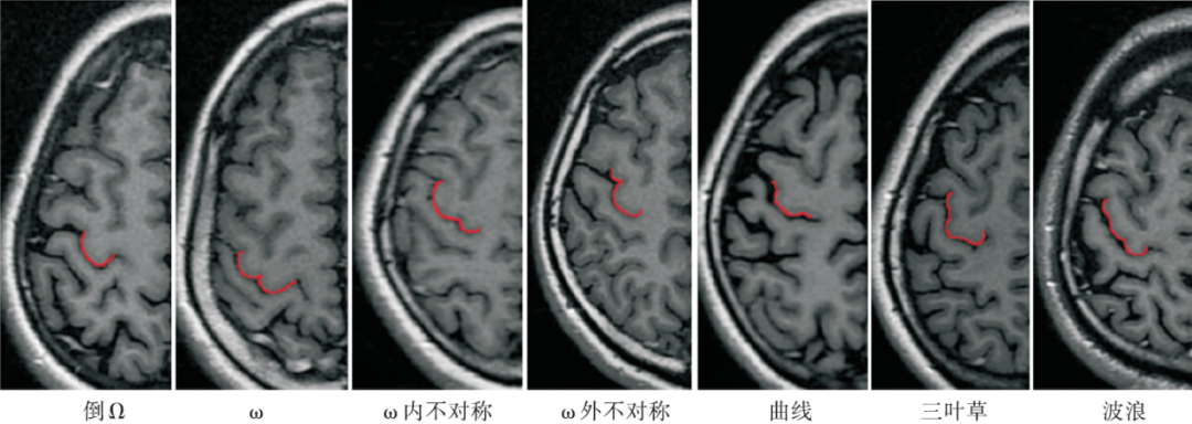 影像PPT - MR上中央前回定位的解剖学标志—手结区-1 影像PPT - MR上中央前回定位的解剖学标志—手结区-1