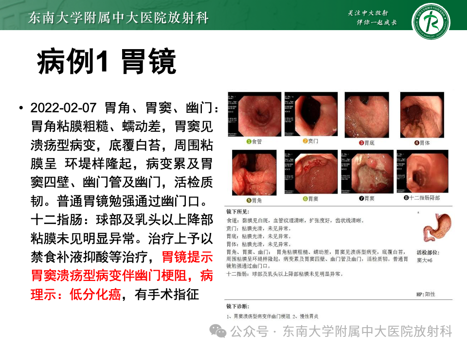 影像PPT - 【病例】胃部/胃周占位随访-4