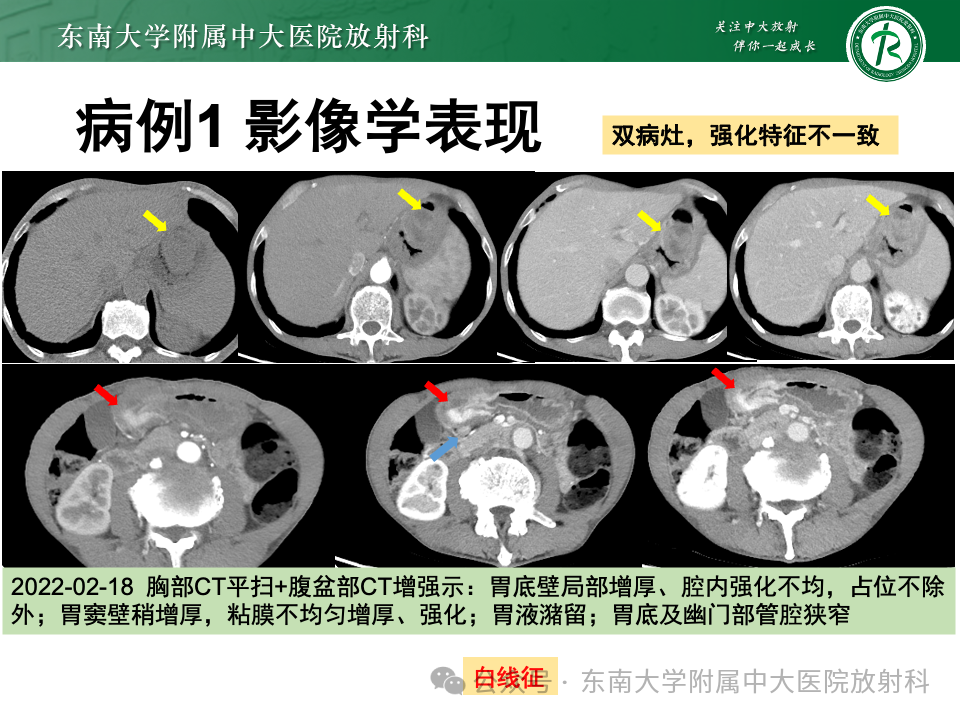 影像PPT - 【病例】胃部/胃周占位随访-3