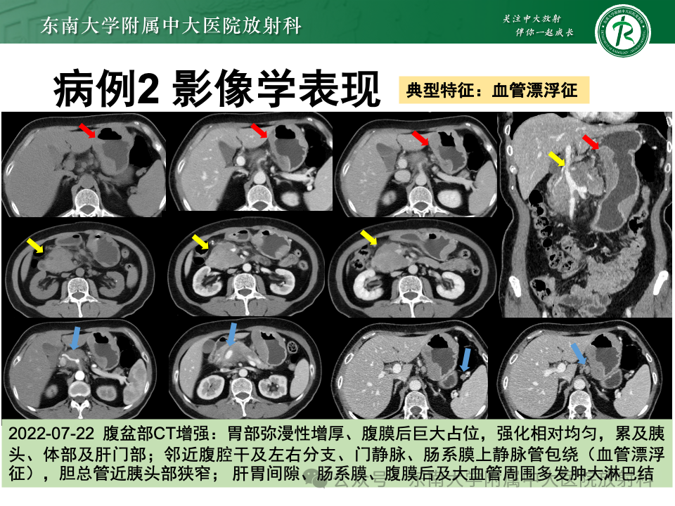 影像PPT - 【病例】胃部/胃周占位随访-12