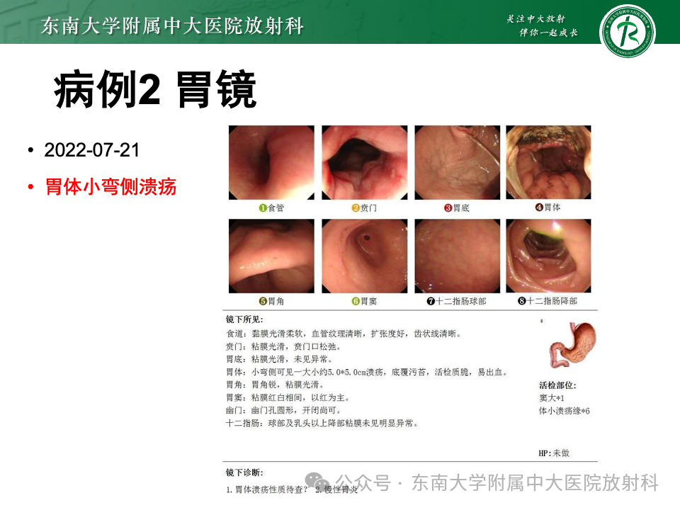 影像PPT - 【病例】胃部/胃周占位随访-14